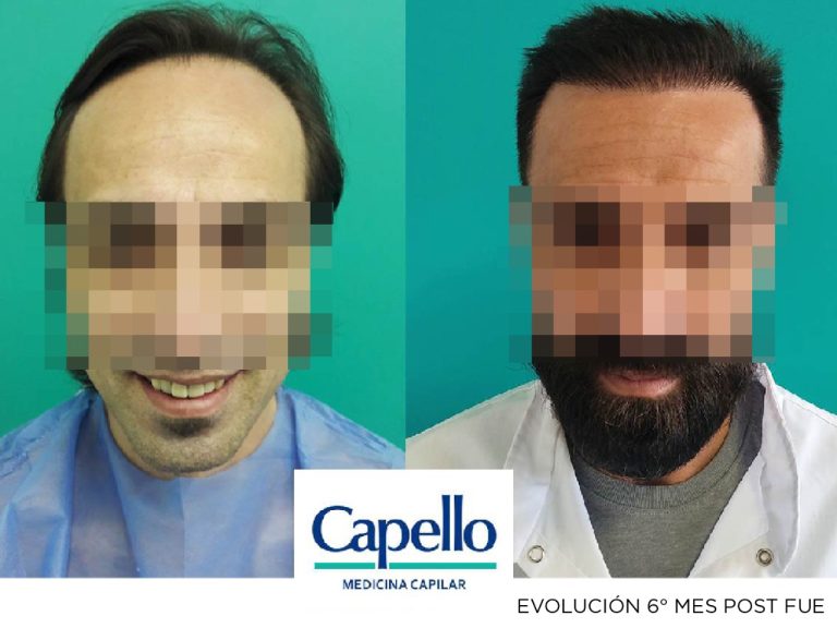 Antes y despues de implante capilar
