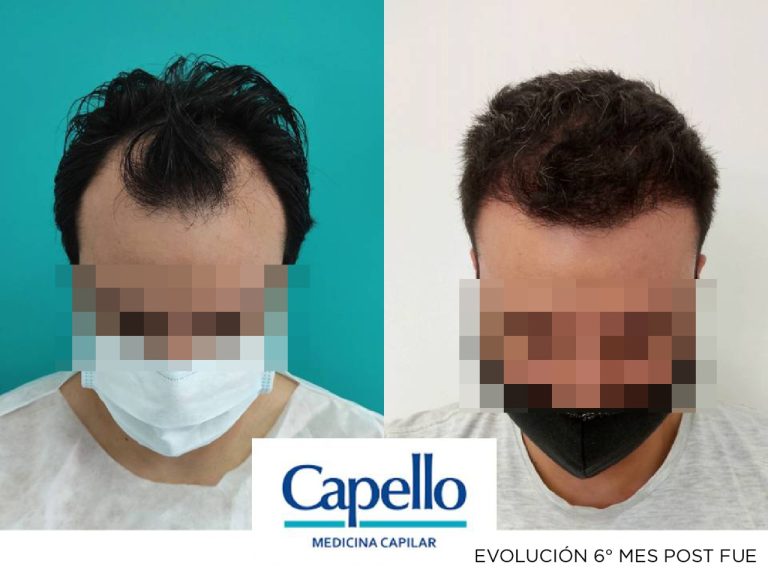 Antes y despues de implante capilar