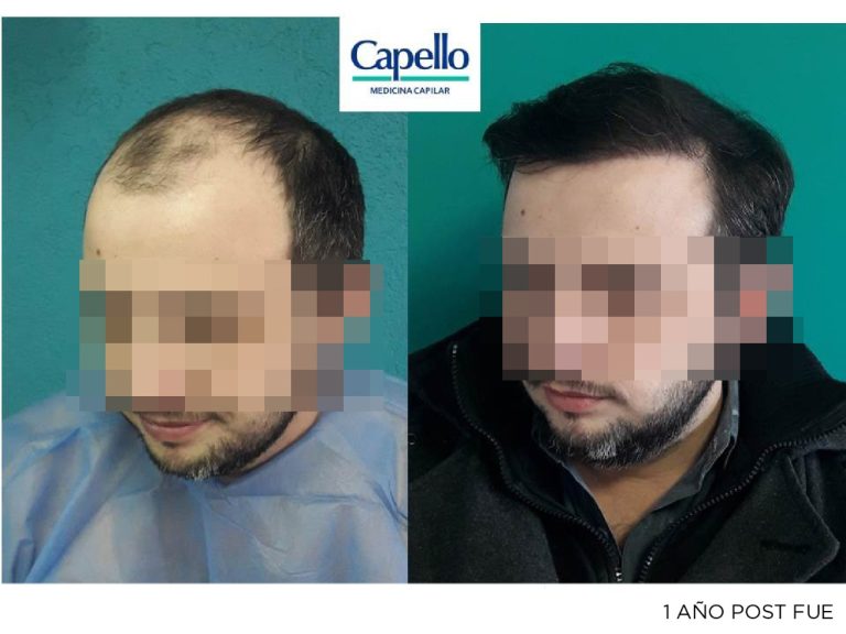 Antes y despues de implante capilar